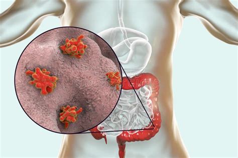 Entamoeba Histolytica Invading Intestine Stock Illustration Illustration Of Medicine Amoeba