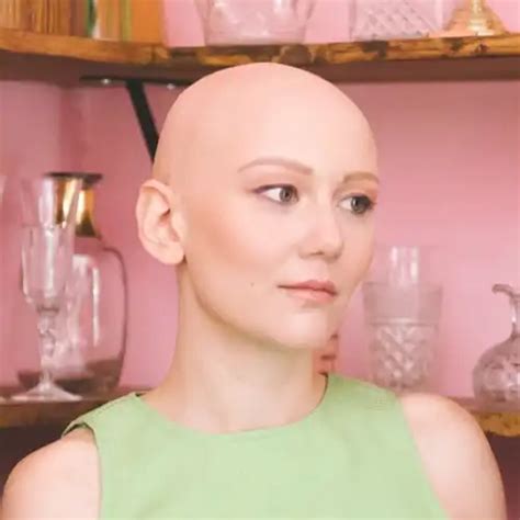 Famous People With Alopecia - My Best Bald Celebrities - Lady Alopecia