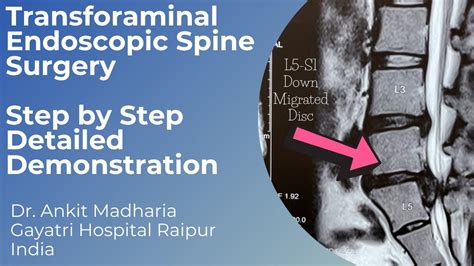 Transforaminal Endoscopic Discectomy L5 S1 Down Migrated Disc Dr