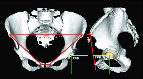 Anterior Pelvic Plane APP And Functional Pelvic Plane FPP