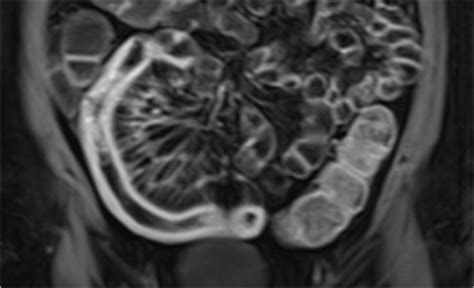 radiology assistant crohns disease role  mri
