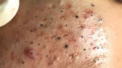 Removendo Espinhas E Cravos Pretos Espremendo Acnes Musica Ambiente