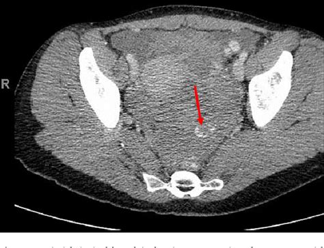 Pdf Postcoital Hemoperitoneum Caused By Ruptured Corpus Luteal Cyst