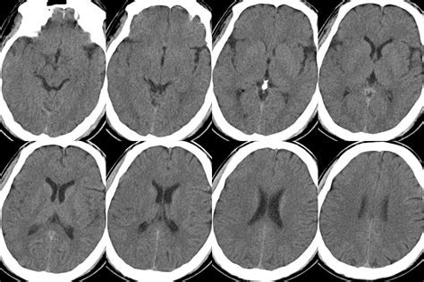 Infarction: Mca Territory Infarct