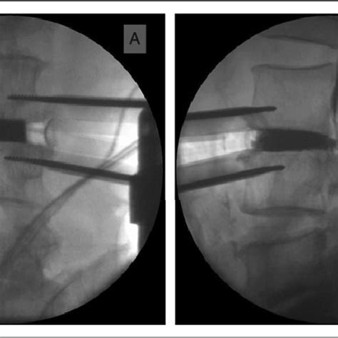 Contrast Filling Technique From Fluoroscopic Anteroposterior A And