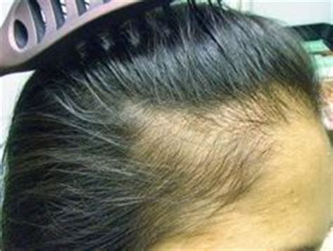 9 Best Traction Alopecia ideas | traction alopecia, alopecia, hair ...