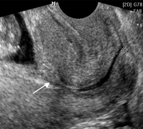 Cervical Length Changes From The First To Second Trimester Of Pregnancy