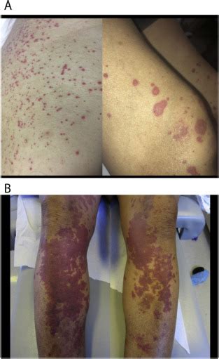 Drug Induced Cutaneous Vasculitis And Anticoagulant Related Cutaneous Adverse Reactions