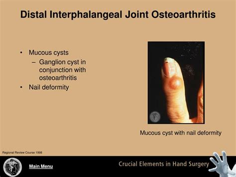 Ppt Arthritis Of The Fingers Powerpoint Presentation Free Download Id 4253847