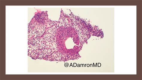 Cystic Neutrophilic Granulomatous Mastitis Example Tips For