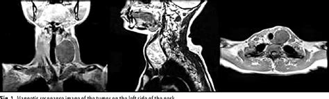 Figure 1 From Neck Nodular Lesions Mimicking Thyroid Tumors Semantic Scholar