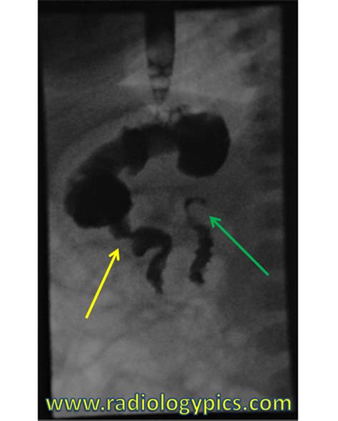 Normal Pediatric Upper Gi Radiologypicscom