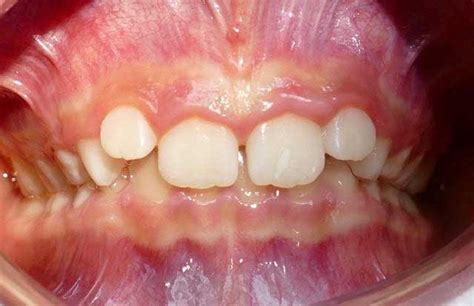 Deep bite - Does my child need braces? - Galen T. Callender