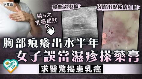 女性健康｜胸部痕癢出水半年 女子誤當濕疹搽藥膏求醫驚揭患乳癌 晴報 健康 腫瘤及癌症 D240327