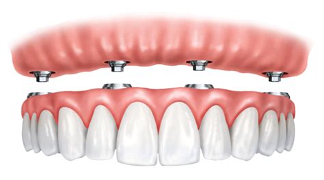 Poa Odontologia Implantes Dent Rios Aruj Dr Almir Feitosa