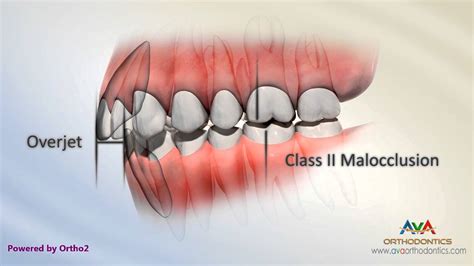 Overjet Aka Overbite Class Ii End On Malocclusion Youtube