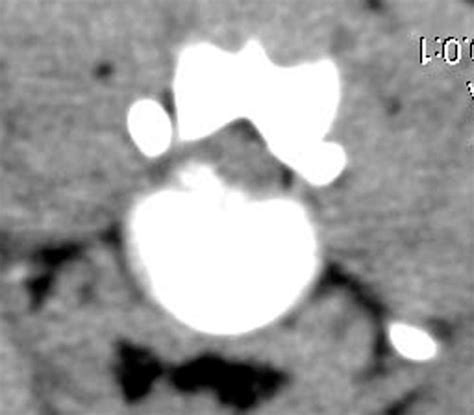 H Rnia Discal Centro De Cirurgia Veterin Ria De Loures