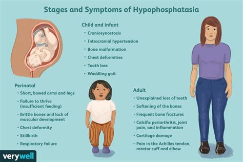 Hypophosphatasia Symptoms Causes Treatment And More