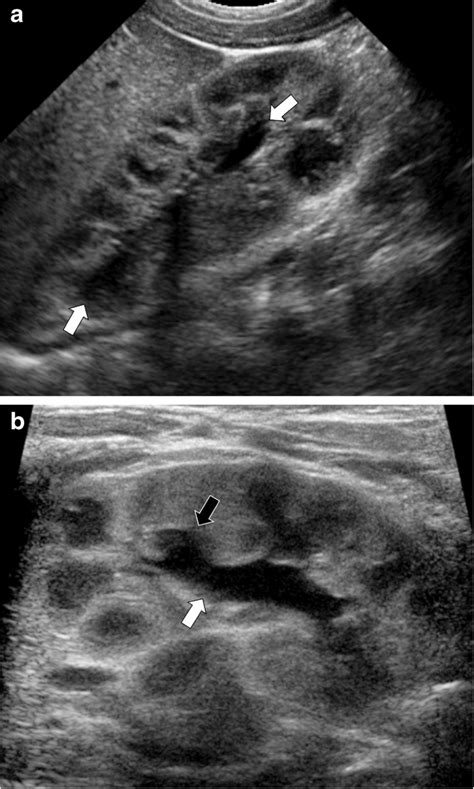 Increased Urinary Tract Dilation In The Prone Versus Supine Positions