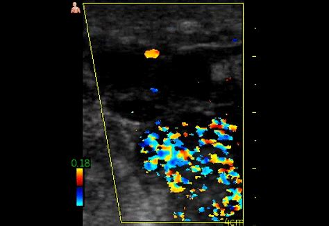 Thrombophlebitis Ultrasound