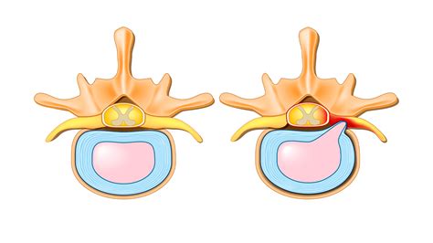 Cervical Foraminal Stenosis – Causes, Symptoms, and Treatment