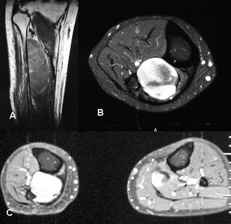 Aand B Mr Image Longitudinal And Transverse Of The Right Leg Showing A