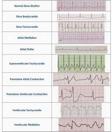 Sinus Tachycardia Vs Atrial Flutter