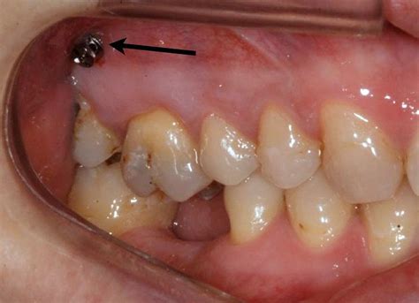 Los microtornillos en ortodoncia Qué son exactamente