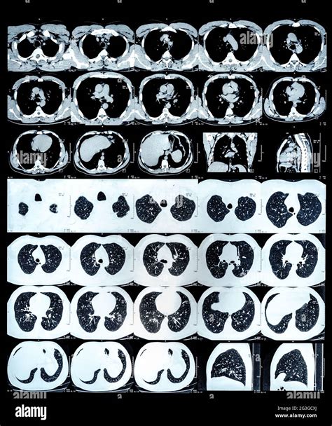 Mri Of Normal Thoracic Spine Banque De Photographies Et Dimages