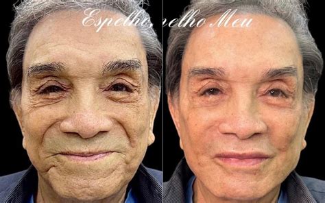 Antes e depois Aos 86 anos Dedé Santana faz harmonização facial