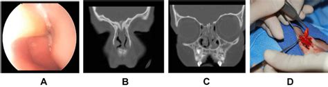 A Endoscopic View Of An Obstructing Nasolacrimal Duct Cyst Ndc On The