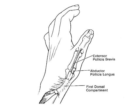 Dequervain S Disease