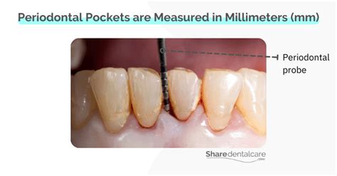 Deep Pockets Between Teeth Causes And Treatment Share Dental Care