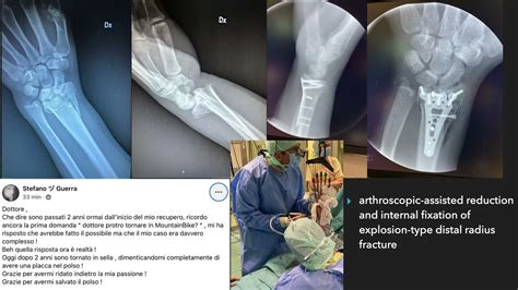 Osteosintesi Con Assistenza Artroscopica Di Una Complessa Frattura Di