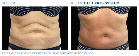 Radio Frequency Tummy Tightening Before And After London