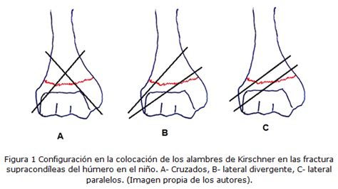 Principios De Fijación Mediante Kirschner En Las Fracturas Supracondíleas De Húmero En El Niño