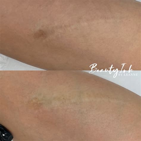 hiding stretch marks with tattoo 12