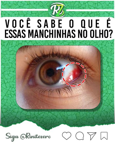 Mancha Vermelha No OLHO Veja O Que Pode SER Mancha Vermelha No Olho