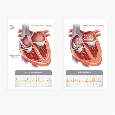 What Is Atrial Fibrillation Get Smart About Afib