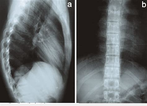 Thoracolumbar Spine X Ray A Lateral View B Anteroposterior View