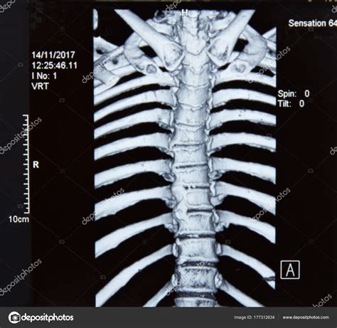 Spine MRI x-ray Stock Photo by ©mandrixta 177312634