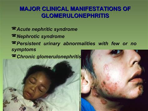 Glomerulonephritis PPT