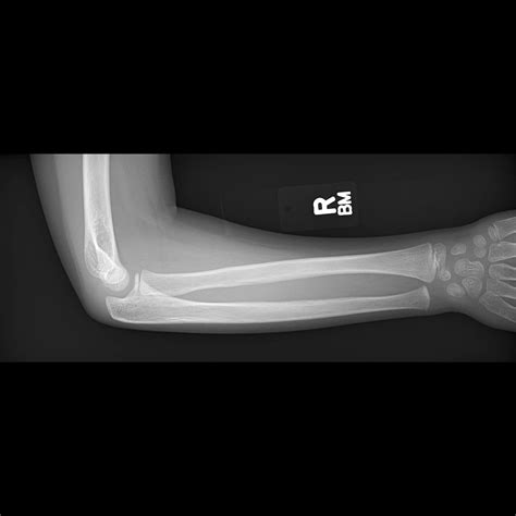 Greenstick Fracture Radius With Ulnar Bowing Image Radiopaedia Org