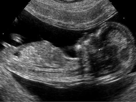 Spina Bifida Ultrasound 12 Weeks