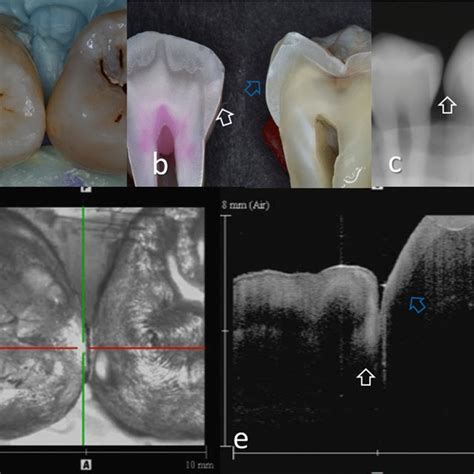 Pdf D Imaging Of Proximal Caries In Posterior Teeth Using Optical