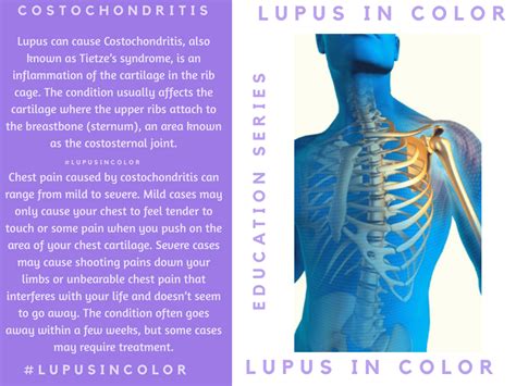 Lupus Education Series