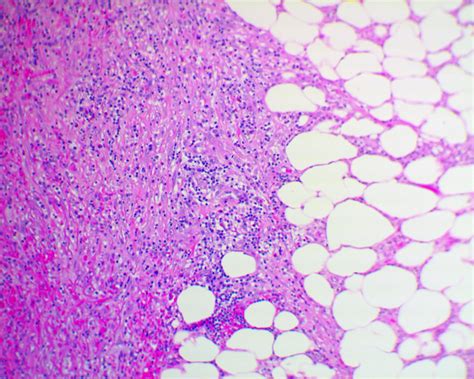 Idiopathic Retroperitoneal Fibrosis Liberal Dictionary