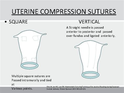 The Simple Solution For Postpartum Hemorrhage Postpartum Haemorrhage