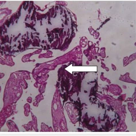 Examination of placenta specimen -image 4 The arrow shows syncytial ...