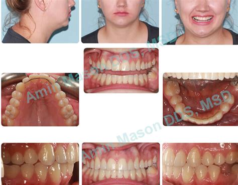 Invisalign Orthodontics Columbus Clear Braces Polaris Orthodontic Center